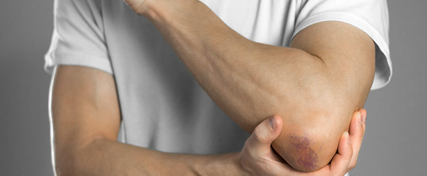 Should I Be Concerned If Bruise Often?￼