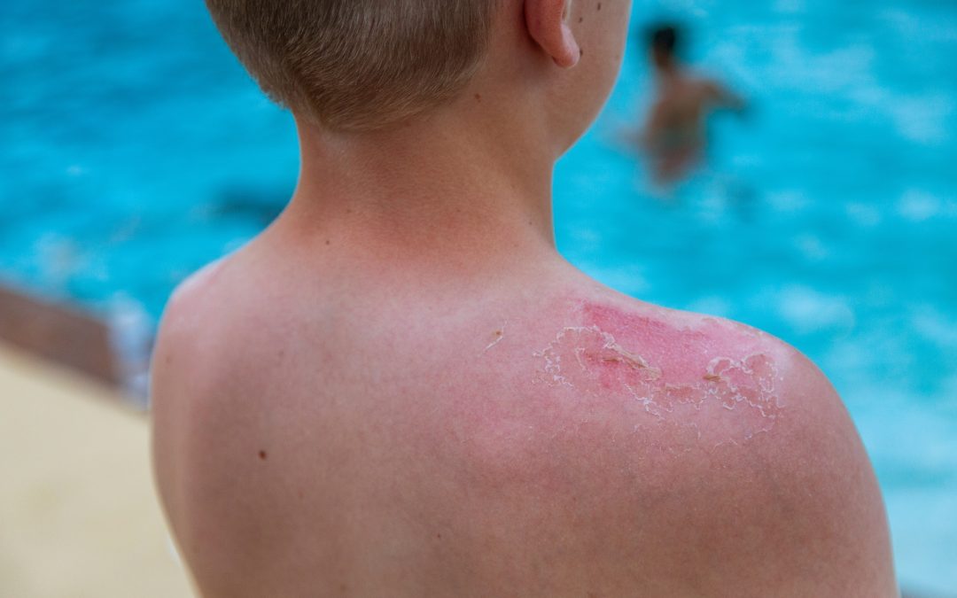 Why is My Sunburn Causing a Rash?