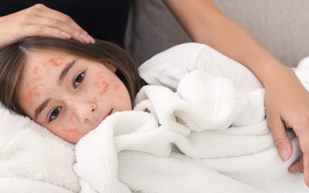 Measles: Symptoms & Causes